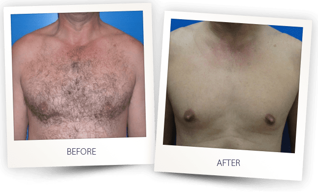 Hair-removal-Chest