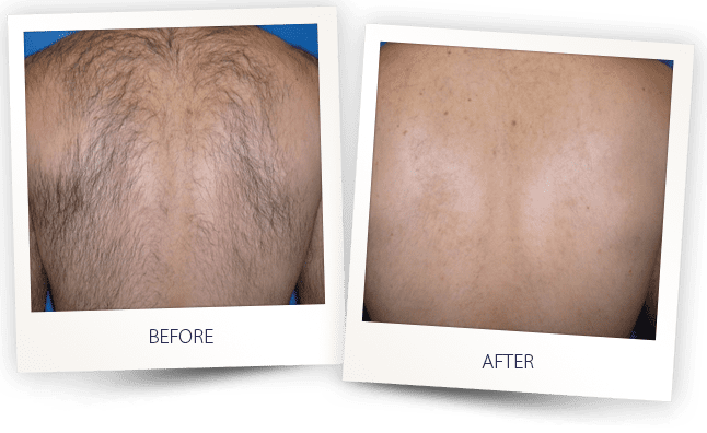 Hair-removal- back