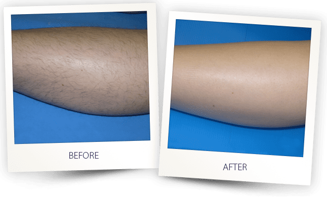 hair-removal-diode Leg